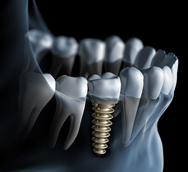 Digital illustration of dental implant