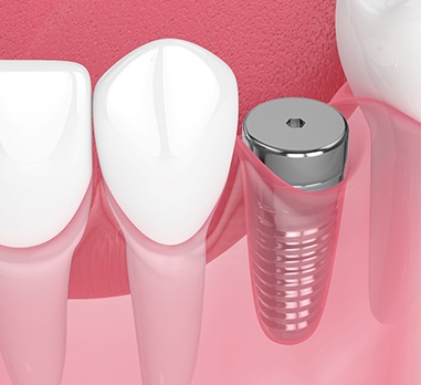 Digital illustration of dental implant without crown