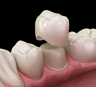 3D illustration Dental crowns on Daniel Island  