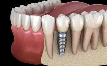 Animated dental implant supported dental crown