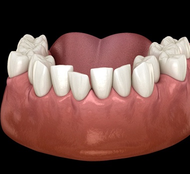 Diagram of crooked teeth in Daniel Island before Invisalign