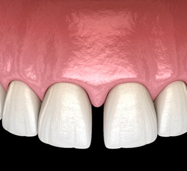 Diagram of gapped teeth in Daniel Island before Invisalign