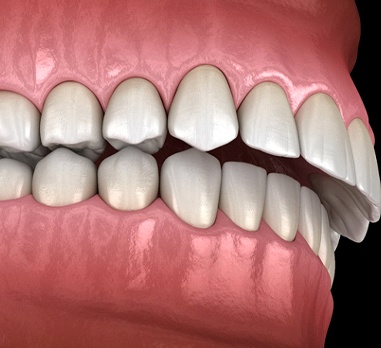 Diagram of overbite in Daniel Island before Invisalign