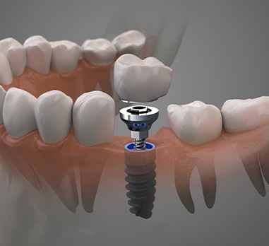 Animated smile during dental implant placement