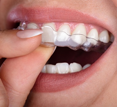 Closeup of teeth with SureSmile clear aligners in place