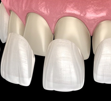 Porcelain veneers being placed over several upper front teeth